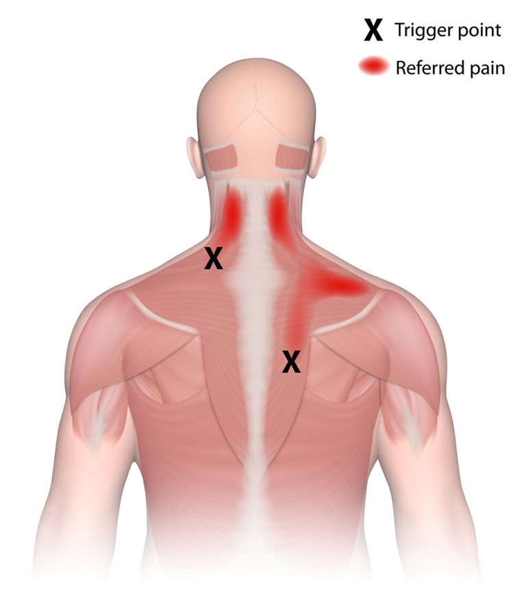 Trigger Points Referred Pain