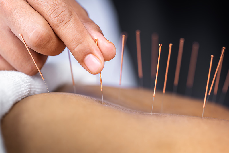 Hand of New York City acupuncturist inserting acupuncture needles in patient's back.