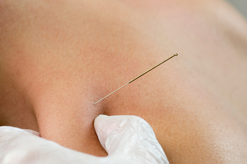 Close-up of dry needle insertion for targeted pain relief in New York City.