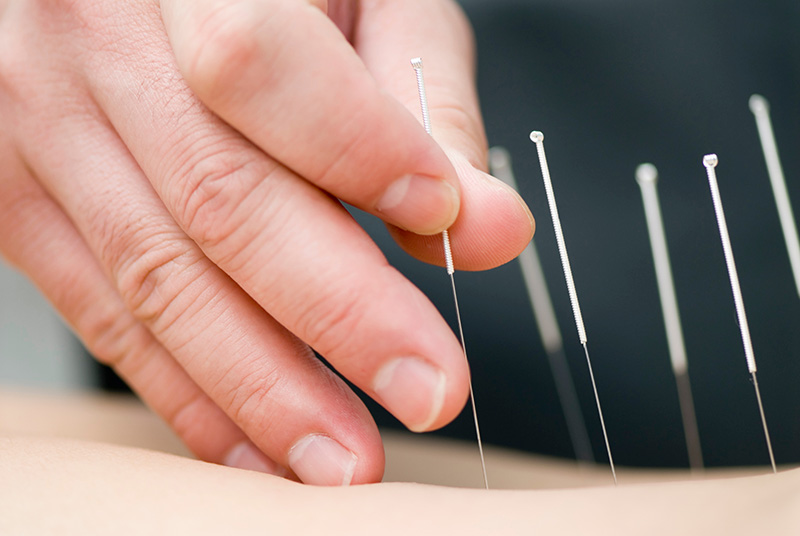 Close-up of a hand inserting acupuncture needles into a patient's skin during a therapy session for pain relief.