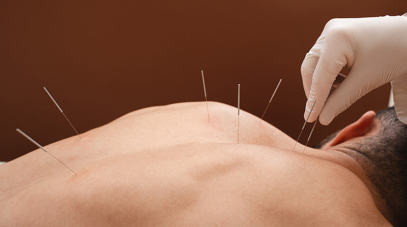 Acupuncturist inserting thin needles into a patient's upper back for therapeutic pain relief.