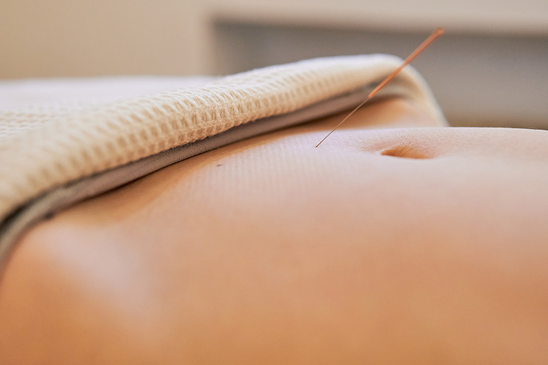 Close-up of an acupuncture needle inserted into the abdominal area, promoting relaxation and holistic wellness through traditional Chinese medicine practices.