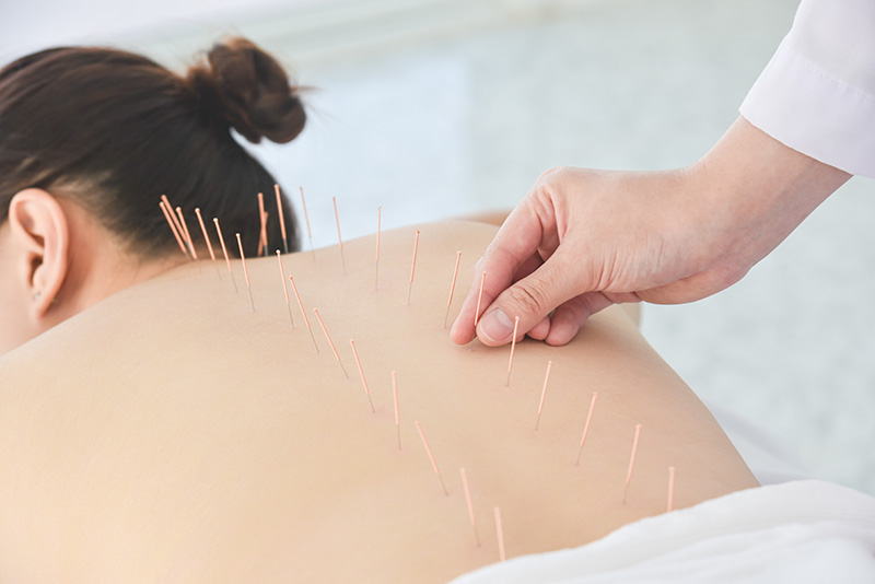 Close up of hands doing acupuncture on patient's back.