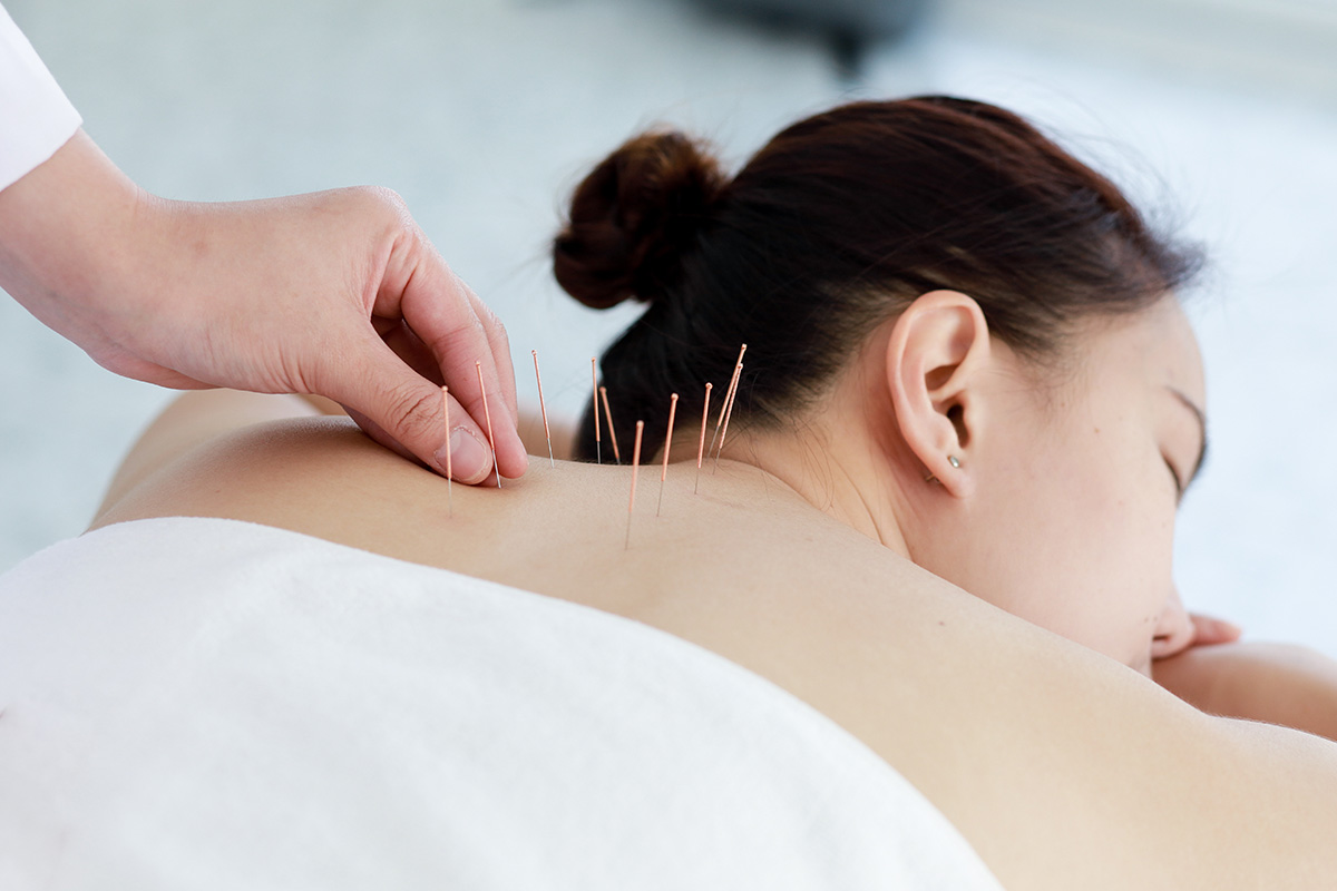Woman undergoing acupuncture treatment