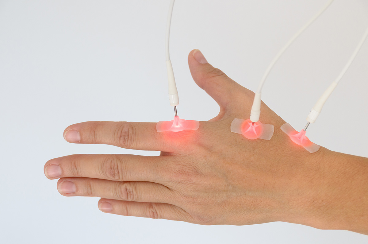 Woman having laser stimulation on her hand